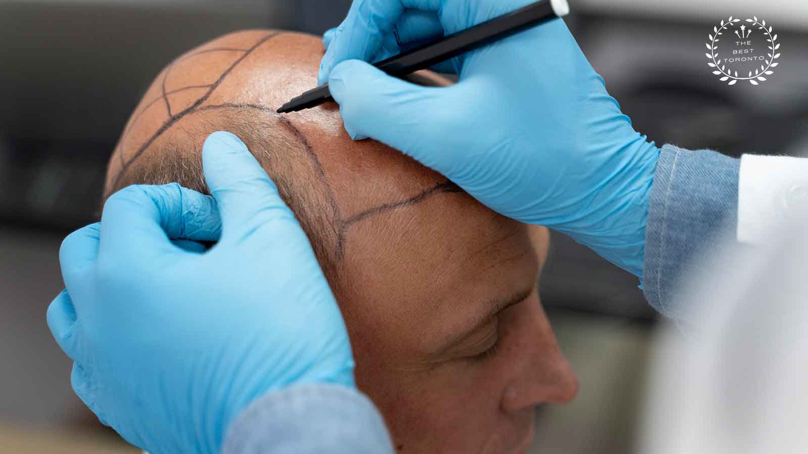 Best Hair Transplant in Toronto