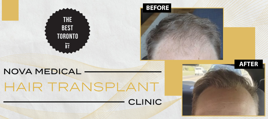 Nova Medical Hair Transplant Clinic