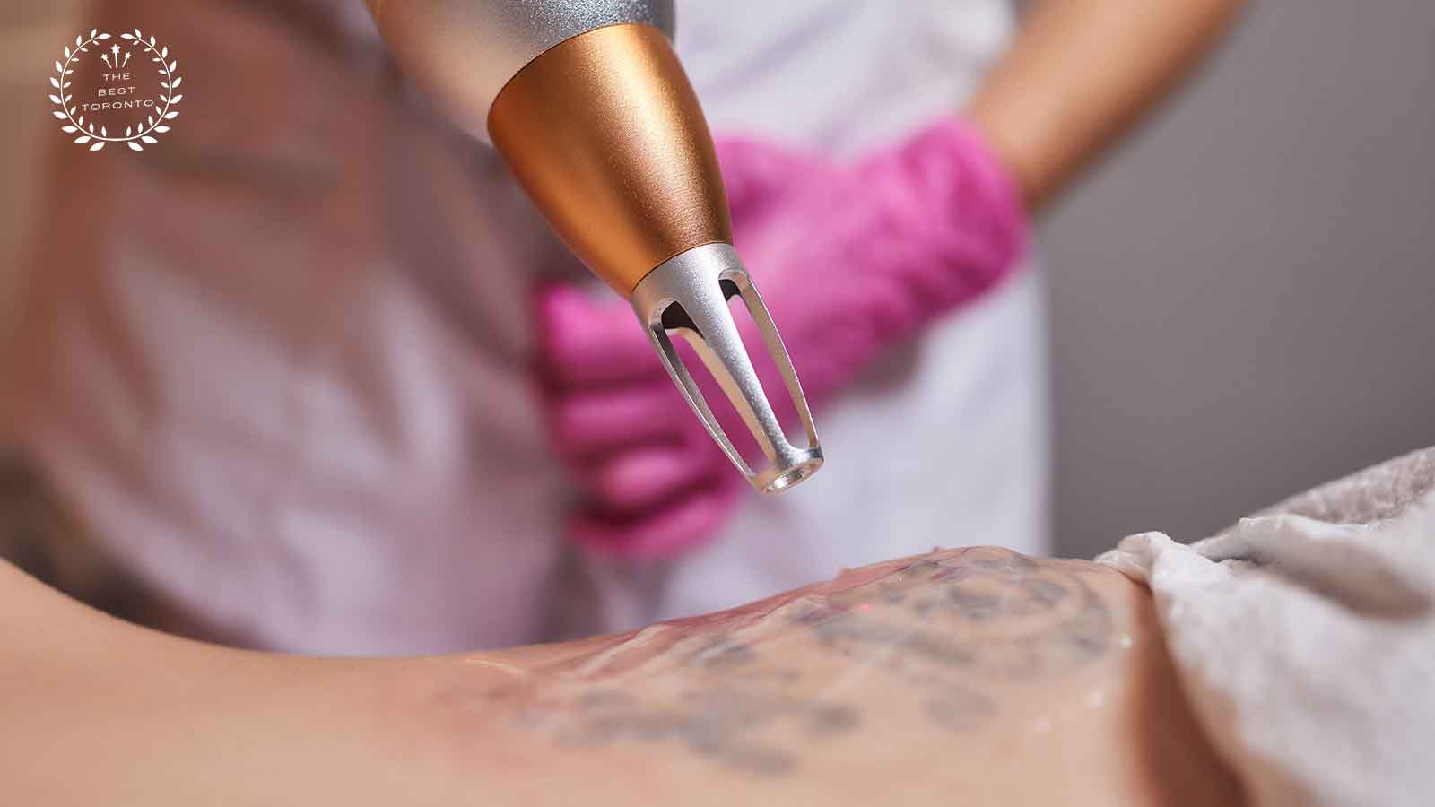Laser Tattoo Removal Toronto - See Before & Afters | SpaMedica