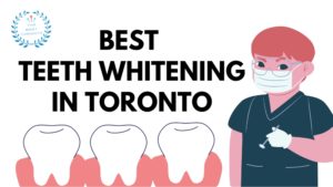 Best Teeth Whitening in Toronto