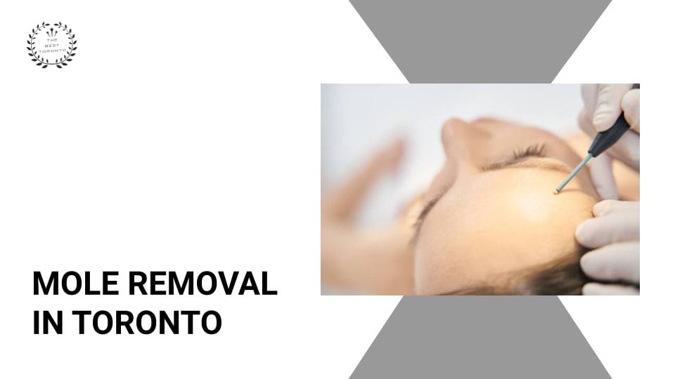 Mole Removal Clinics