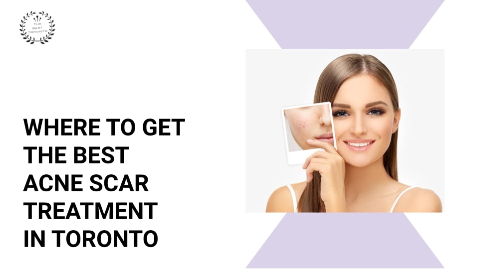 Where to Get the Best Acne Scar Treatment in Toronto