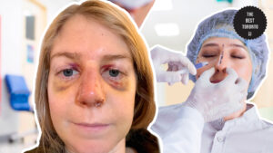 Post-Operative Risks