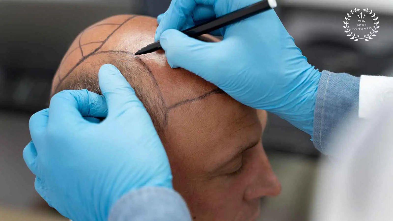 Best Hair Transplant in Toronto