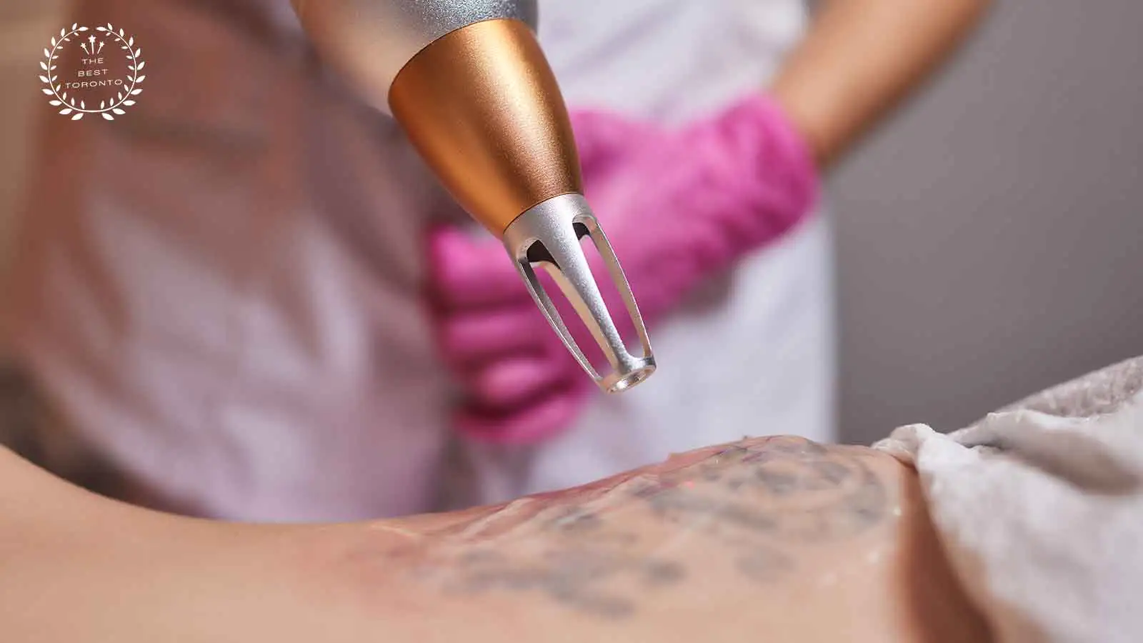 The 7 Clinics for the Best Tattoo Removal in Toronto [2023 ]