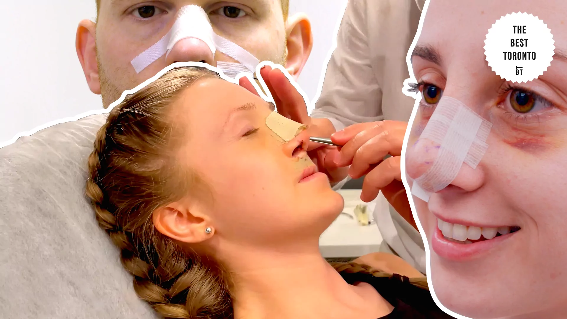 bandaged-rhinoplasty-patient